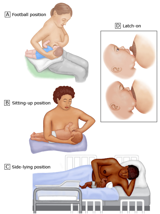 BODY ICE Woman - HEALING💕 Sore nipples are very common for breastfeeding  women. Common causes may include: • a baby not latching well • chafing •  thrush • adapting to this new